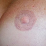 nipple-reconstruction-ear-1