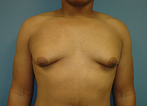 gynecomastia_3