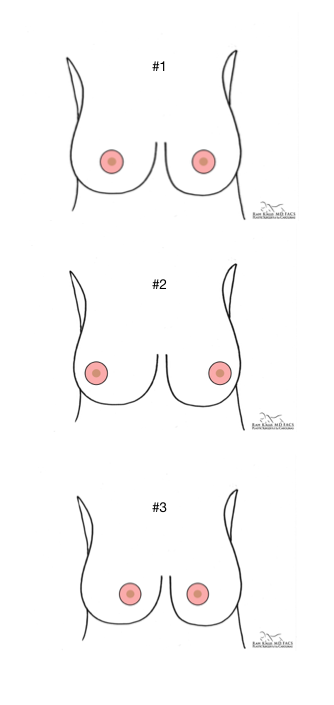 How Breast Shape and Nipple Position Factor into Breast Augmentation