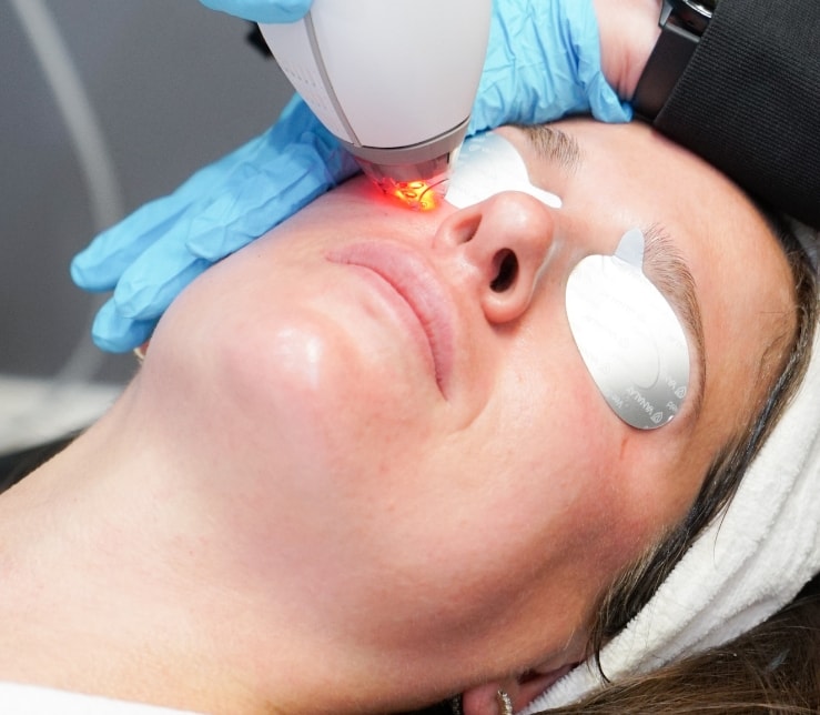 Laser Treatments