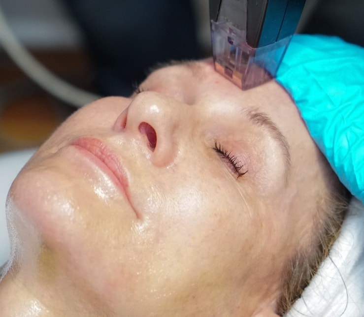 Skin Tightening